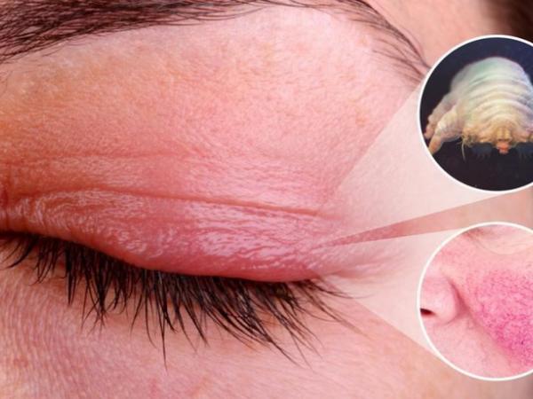 Ocular Demodicosis photo