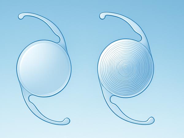 Monofocal vs. Multifocal IOLs: Which Is Right for You? photo