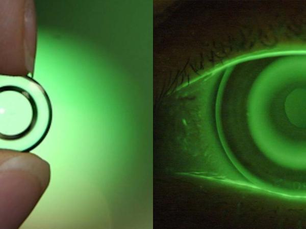 Orthokeratology lenses photo