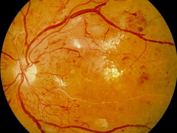 Panretinal photocoagulation (PRP therapy) photo