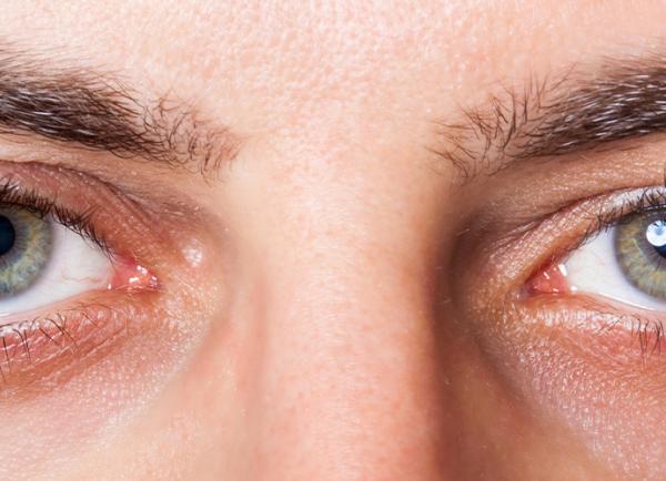 Redness of the eyes - when you need to see a doctor photo