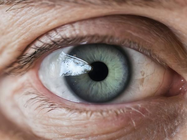 Types of Cataracts photo