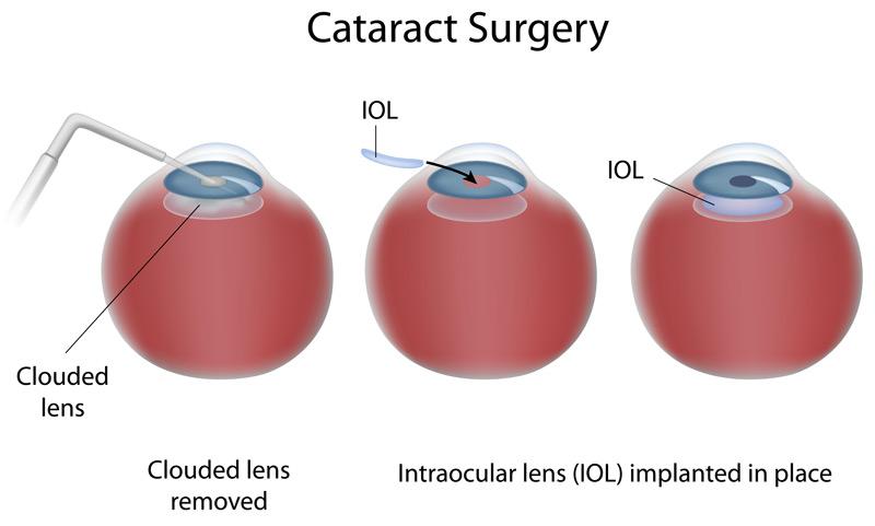 Efficient cataract treatment: intraocular lens replacement photo