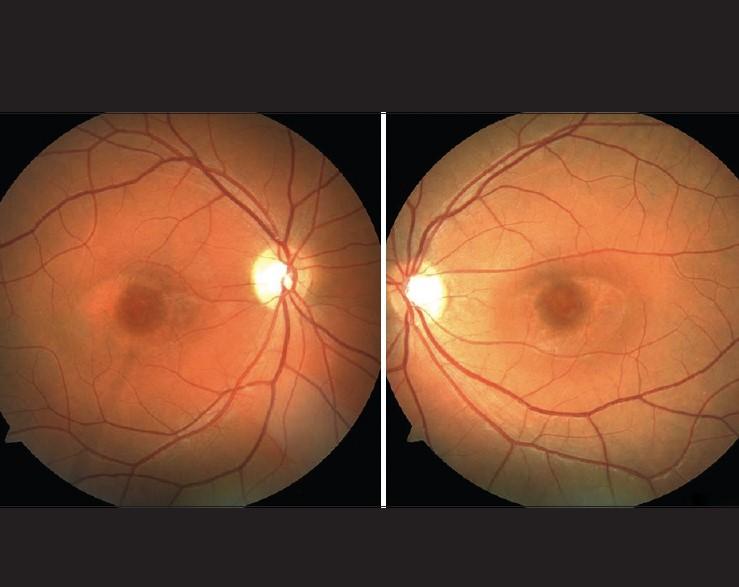 Bull's Eye Maculopathy: Understanding Causes, Symptoms, and Treatment Options photo