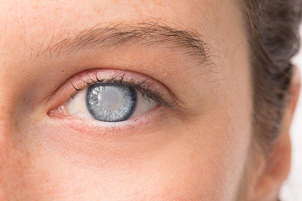 10 myths about cataracts photo