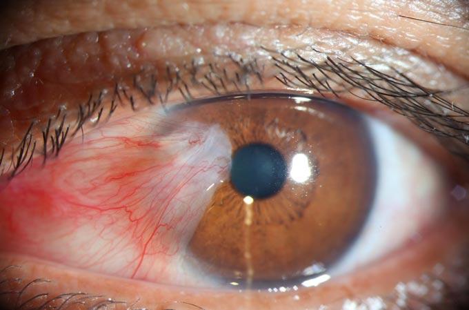 Battling the Winds of Eye Health: Decoding Pterygium and Its Effects photo
