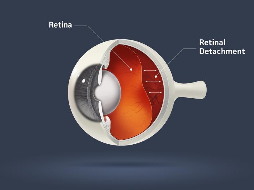 Retinal detachment photo