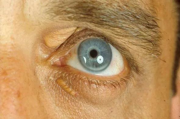 A Comprehensive Exploration of Xanthelasma Causes, Diverse Treatment and Approaches photo