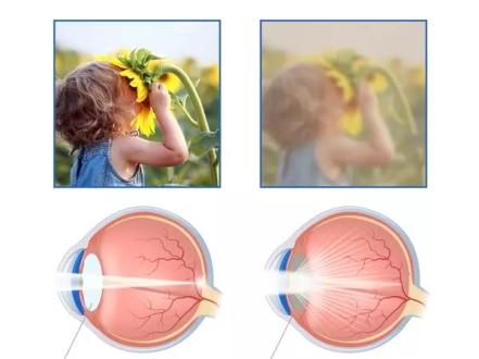 All about cataract photo