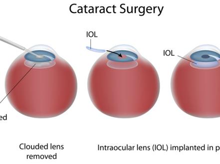 Efficient cataract treatment: intraocular lens replacement photo