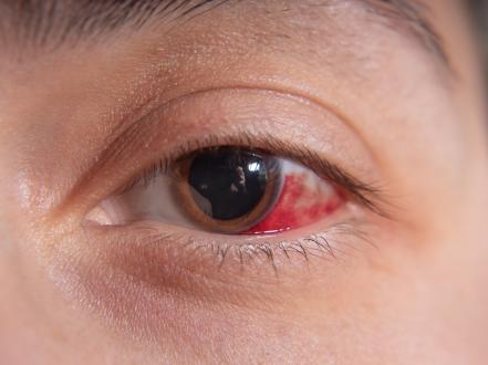 Knowing Pink Eye: Symptoms, Causes, and Treatment Approaches photo