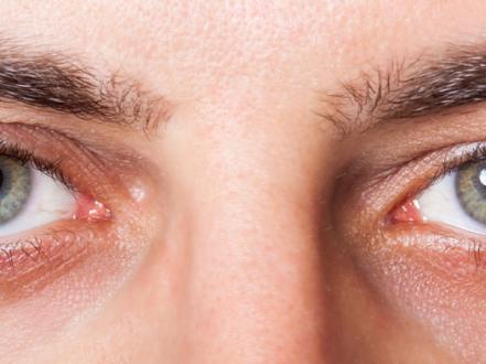 Redness of the eyes - when you need to see a doctor photo
