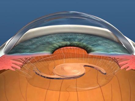 What you should know about intraocular lenses: best treatment for cataracts photo