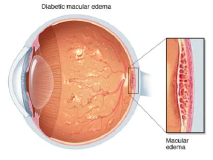 Diabetic macular edema photo