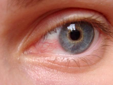 Understanding Uveitis and its Impact on Vision photo