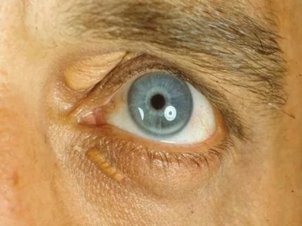 A Comprehensive Exploration of Xanthelasma Causes, Diverse Treatment and Approaches photo
