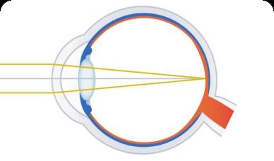 Online test for nearsightedness, farsightedness, emmetropia (Duochrome test)