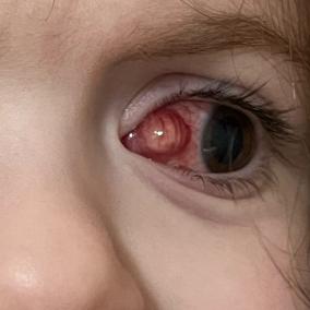 Pediatric Ophthalmology Strbsms photo