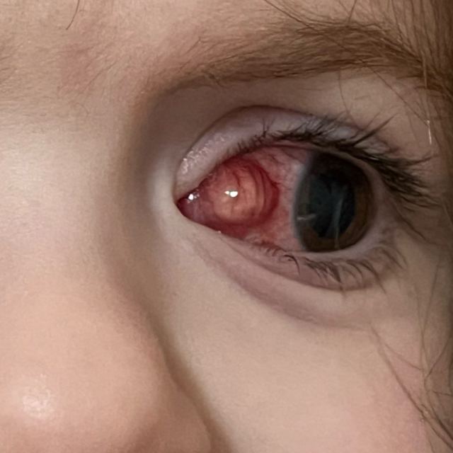 Pediatric Ophthalmology Strbsms photo