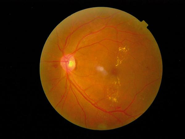 Clinically Significant Macular Edema (CSME) photo
