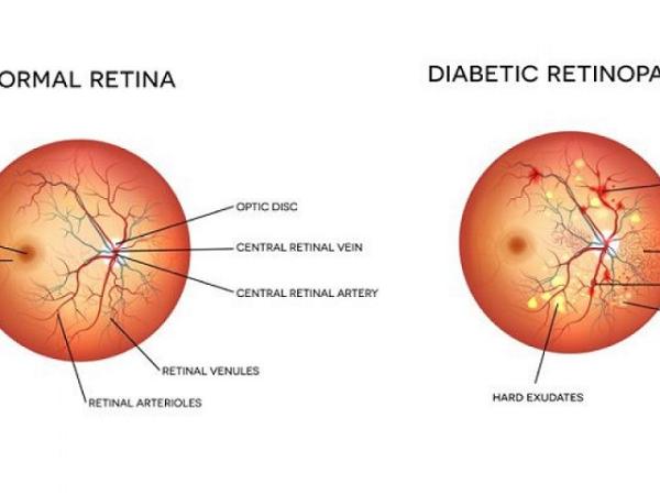 Diabetic retinopathy: symptoms and treatment photo