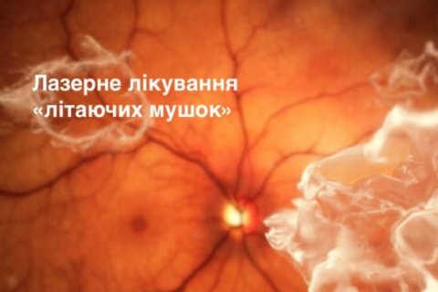 Laser treatment of eye floaters photo