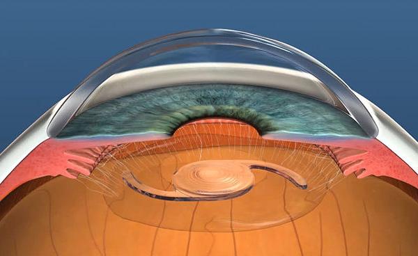 What you should know about intraocular lenses: best treatment for cataracts photo