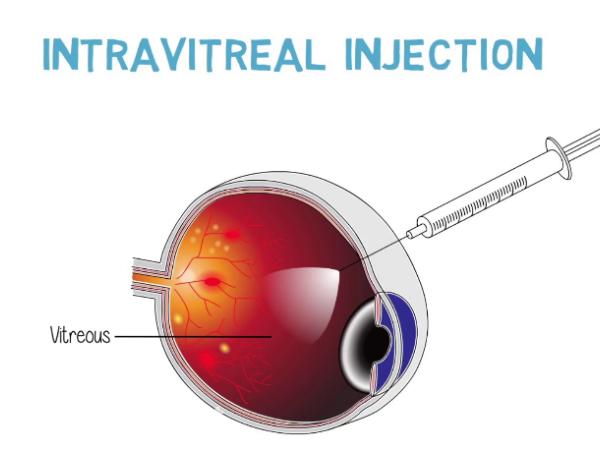 Intravitreal injections for the treatment of diabetic macular edema photo
