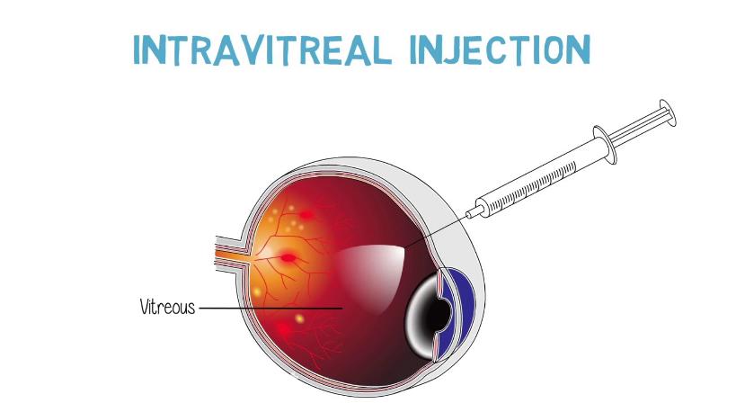 Intravitreal injections for the treatment of diabetic macular edema