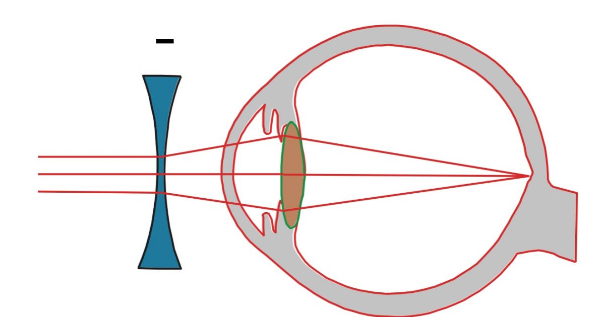 Progressive myopia | MyVisionCare.org